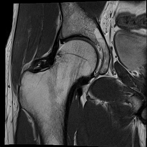 normal hip MRI coronal view 3 Diagram | Quizlet