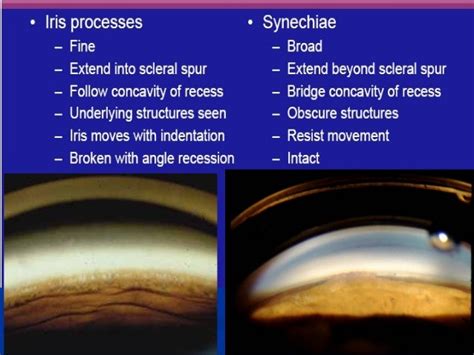 Gonioscopy presentation