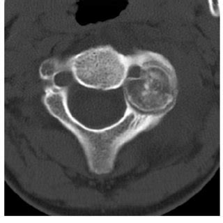 (PDF) Staging and treatment of osteoblastoma in the mobile spine: A ...