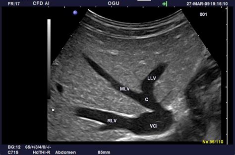 (Ch:02) Ultrasound of the Liver – EFSUMB