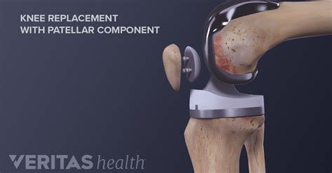 The Pros and Cons of Minimally Invasive Knee Replacement Surgery