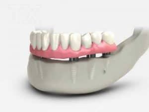 All on 4 Dental Implant Reviews Problems & Complications