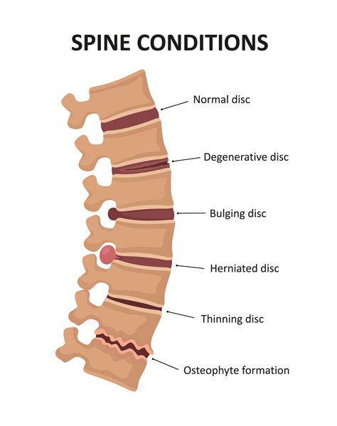 Degenerative Disc Disease