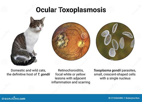 Ocular Toxoplasmosis, Retinal Scar Caused By A Toxoplasma Gondii ...