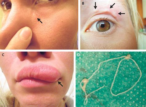 Lump On Woman's Face Turns Out To Be A Parasite Crawling Under Her Skin ...