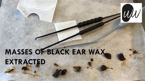 532 - Masses of Black Ear Wax Extracted | The Wax Whisperer - YouTube