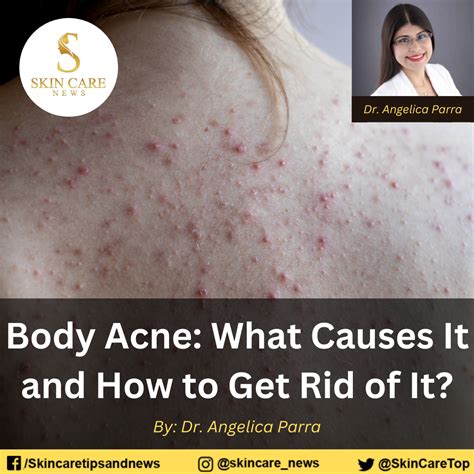 Body Acne: What Causes It and How to Get Rid of It?