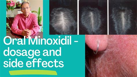 Oral Minoxidil for hair disorders - dosage and side effects - YouTube