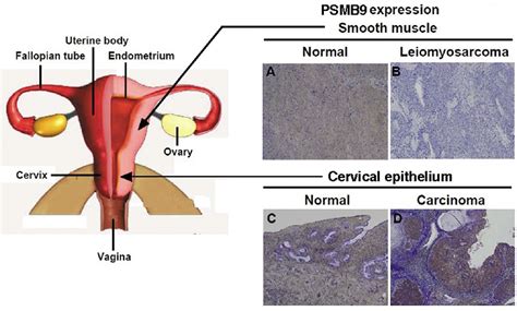 Molecular Pathology and Novel Clinical Therapy for Uterine ...