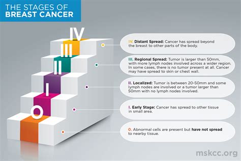 Breast Cancer Stages 0, 1, 2, 3 and 4 | Memorial Sloan Kettering Cancer ...