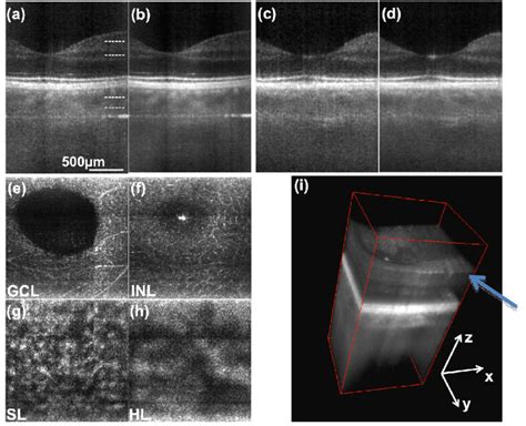 3D retinal images of parafoveal region. (a) single frame tomogram in ...