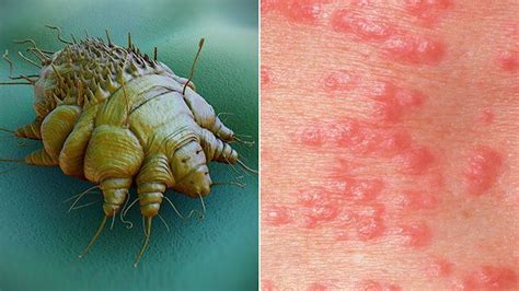 Scabies: Causes, Rash Signs & Treatment Options