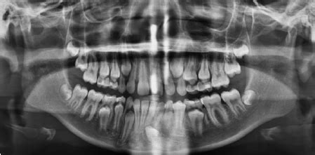 Panoramic radiograph showing patient’s dentition in the mixed dentition ...