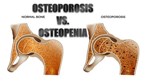 Osteoporosis vs. Osteopenia: What's The Difference? - El Paso, TX.