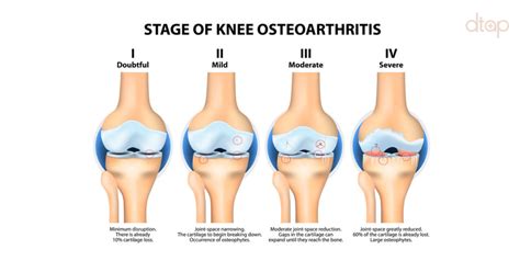 Osteoarthritis Knee (OA) | Men's Health Clinic in Singapore