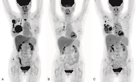 Breast Cancer Metastases-Bone | PracticeUpdate