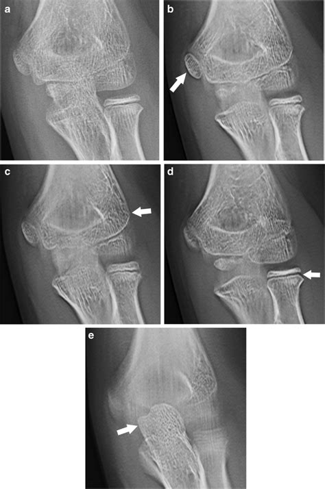 X Ray Elbow Normal