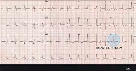 Electrocardiogram Quiz | Emergency Medicine Education | Resus