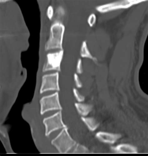 Osteoblastoma - cervical spine | Image | Radiopaedia.org