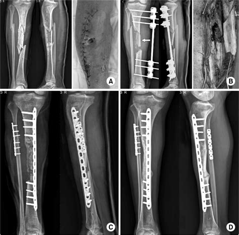 Tibial Fracture X Ray