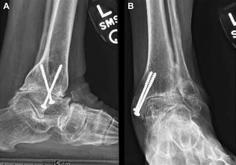 Talus Bone Fracture