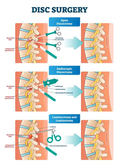 Laminectomy | Methodist McKinney Hospital