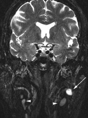 Pleomorphic Adenoma Imaging: Practice Essentials, Computed Tomography ...