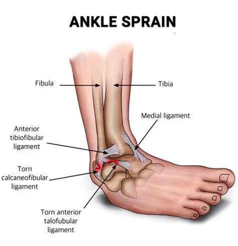 How To Cure A Sprang Ankle - Computerconcert17