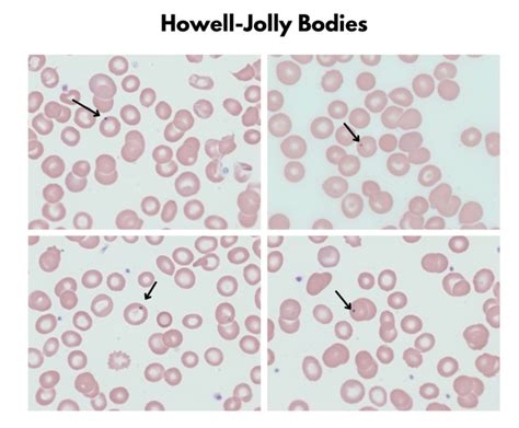 Red Blood Cell Inclusions • The Blood Project