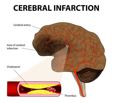 Cerebral infarction or ischemic stroke — Stock Vector © edesignua #53168923