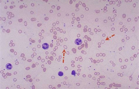 Hypochromic microcytic anemia on peripheral smear | Medical Laboratories