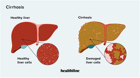 Cirrhosis: Incidence, Symptoms, and Treatment