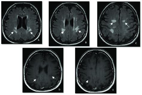 Case III. (A-C) Axial T2/FLAIR brain MRI shows periventricular ...