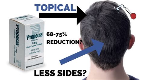 Topical Finasteride: Science, Pros and Cons and Practical Tips - YouTube