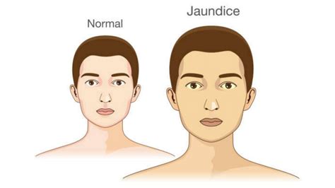 Jaundice - Causes, Types, Symptoms, and Treatment - Solution Parmacy