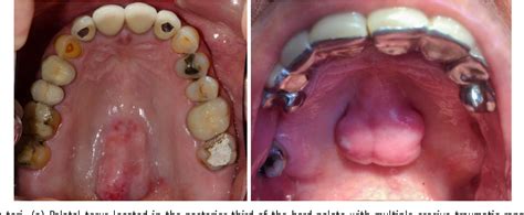 [PDF] Palatal torus: etiology, clinical aspect, and therapeutic ...