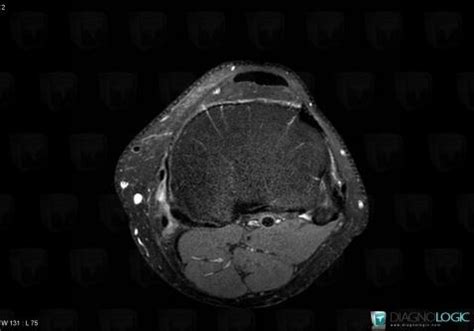 Radiology case : Pes Anserinus tendinopathy (MRI) - Diagnologic