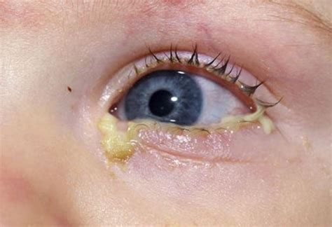 Pink Eye (conjunctivitis) - Symptoms and Treatment | Things Health