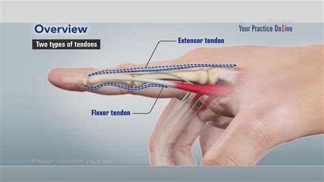 Flexor Tendon Injuries Video | Medical Video Library