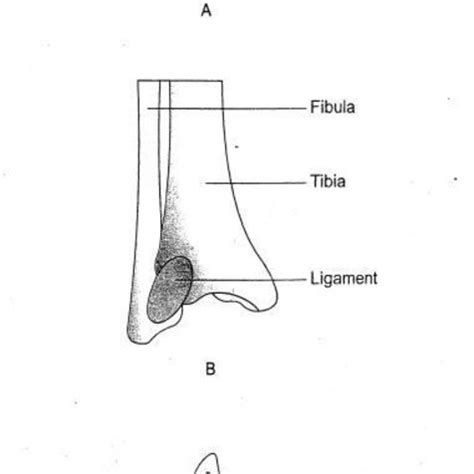 1: The fibrous joint: A, suture; B, syndesmosis; and C, gomphosis ...