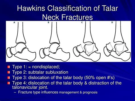 Types Of Talus Fractures