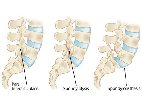 Spondylolysis and Spondylolisthesis - OrthoInfo - AAOS