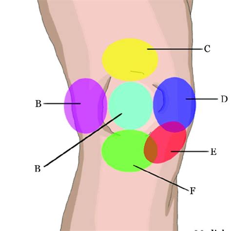 Differential diagnosis of knee pain based on location. Knee pain is a ...