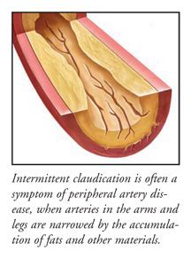 Intermittent Claudication