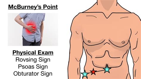 Appendicitis Pain Location Diagram