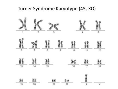 Turner syndrome