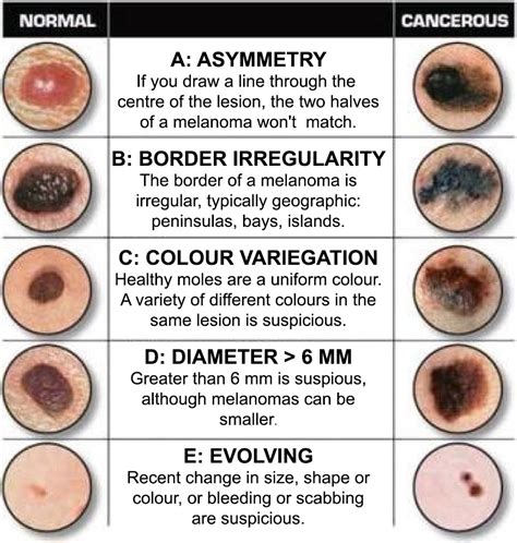 The Abcdes Of Melanoma Saguaro Dermatology | Images and Photos finder