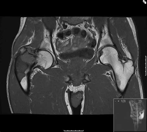 MRI scan of the pelvis demonstrating the fibrous dysplasia of the right ...