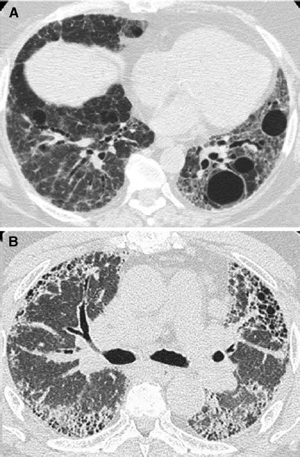 Diffuse cystic lung disease associated with interstitial lung diseases ...