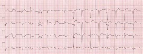 High Lateral STEMI • LITFL • ECG Library Diagnosis